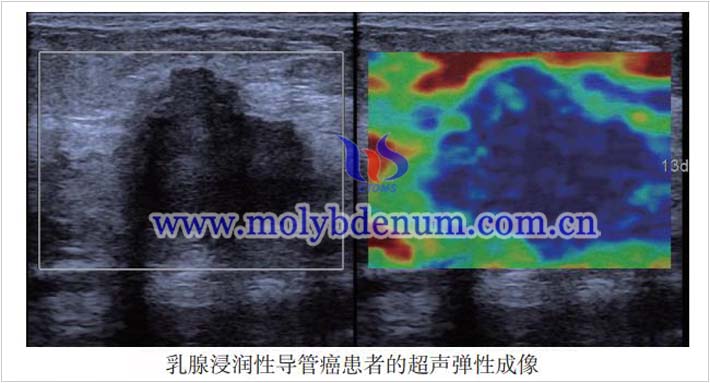 超聲彈性成像與鉬靶X綫診斷效果如何圖片