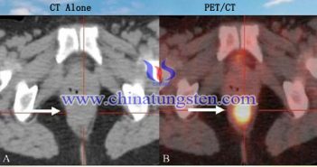 PET-CT ???? ??? ??? ?? ?????