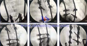 首套國(guó)產(chǎn)鈷鉻鉬脊柱內(nèi)固定系統(tǒng)啟用圖片