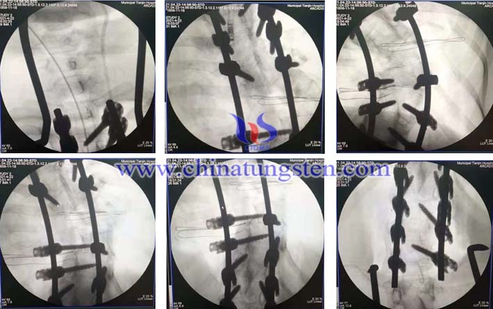 首套國(guó)產(chǎn)鈷鉻鉬脊柱內(nèi)固定系統(tǒng)啟用圖片